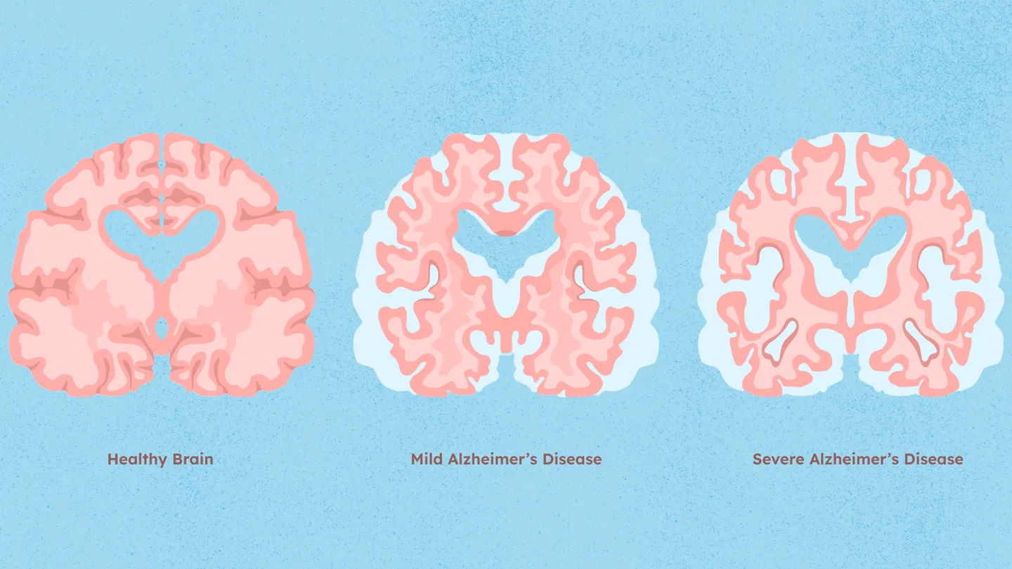 Alzheimer’s Brain Scan Modeling (Wharton DSA)